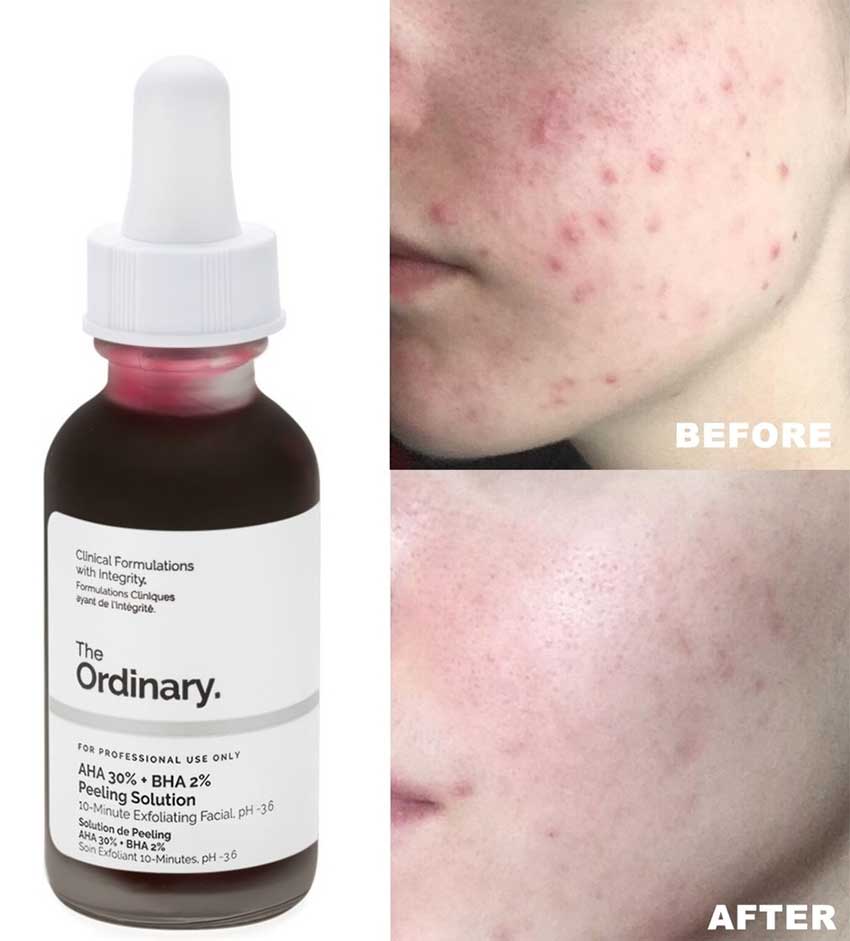 The Ordinary AHA 30% + BHA 2% Peeling Solution | Sérum exfoliante